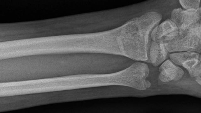 男子手部修复后的骨头在折断和去除石膏后进行x光检查，缩小