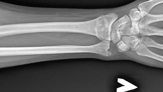 手臂骨折的x光。人体解剖学，移位的骨损伤图像