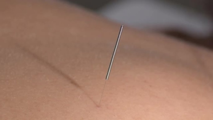 女性患者背部的针灸针尖刺