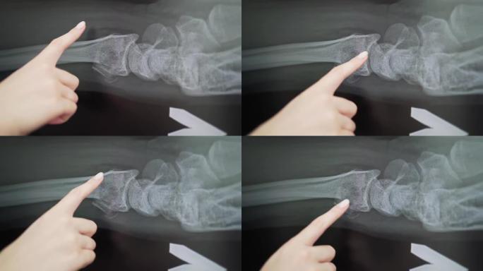 移位的桡骨骨折的x射线。医生正在研究受伤的骨头。放射科医生在诊所4k进行诊断