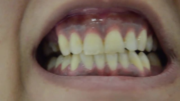 露出丑不刷断牙的人-牙齿卫生