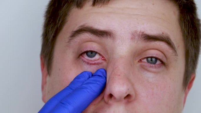 医生-眼科医生用蓝色医用手套检查患者的眼睛。眼睛和角膜护理的概念。怀疑结膜炎