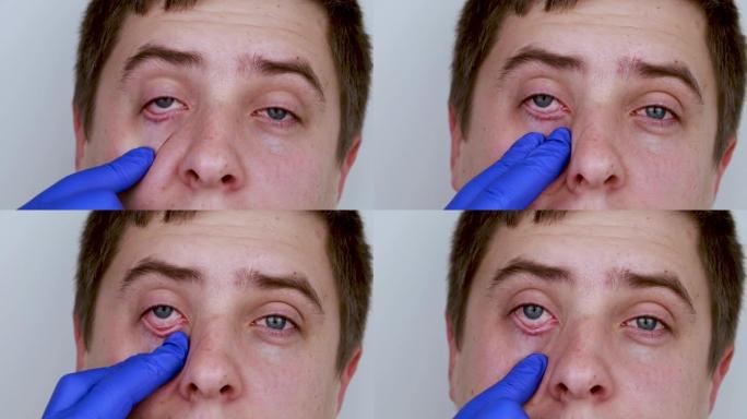 医生-眼科医生用蓝色医用手套检查患者的眼睛。眼睛和角膜护理的概念。怀疑结膜炎