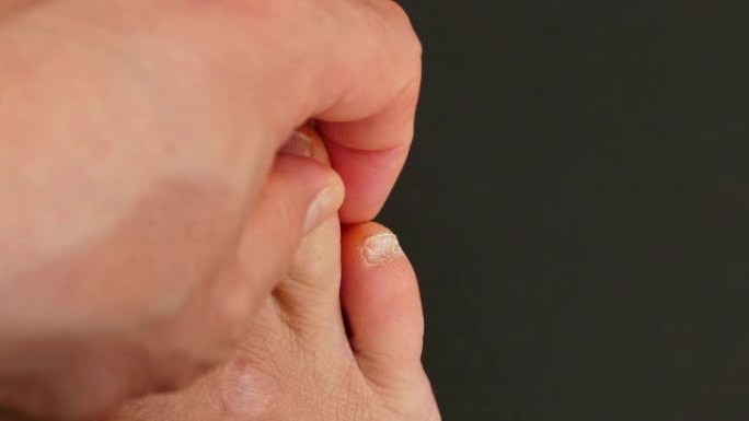 脚趾之间的真菌病，一种有足部护理的人的脚，被忽视的真菌病，