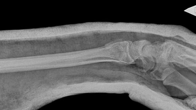 骨复位后的手x光。创伤外科医生手术后手臂骨折的图片