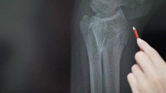 手臂骨的x光。放射科医生检查裂纹4k