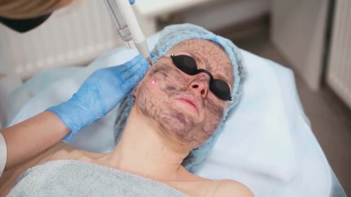 女性面部激光光子嫩肤和碳剥离。黑色面罩。皮肤病学和美容学。使用手术激光。