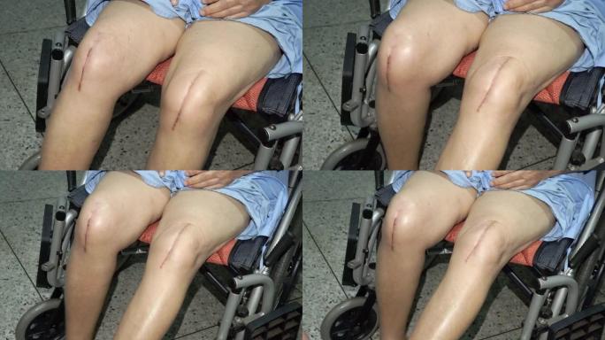 亚洲老年或老年老太太患者在护理医院病房显示疤痕手术全膝关节置换缝合伤口手术人工关节置换术: 健康强烈