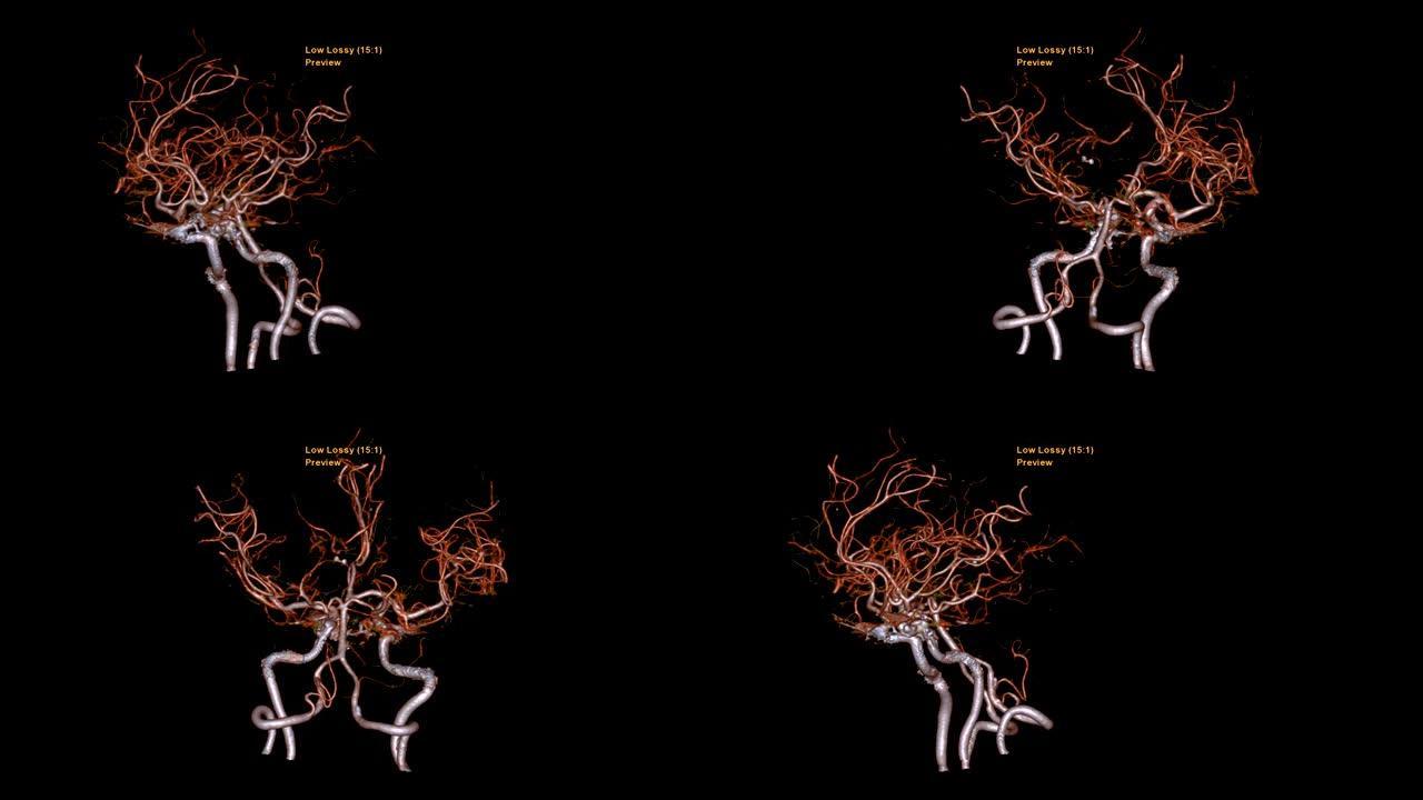 CTA脑或计算机断层扫描血管造影的大脑3D渲染图像显示大脑的脑动脉在屏幕上旋转。