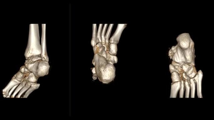 CT踝关节或右踝关节的ct扫描3D渲染图像在屏幕上旋转显示距骨骨折。
