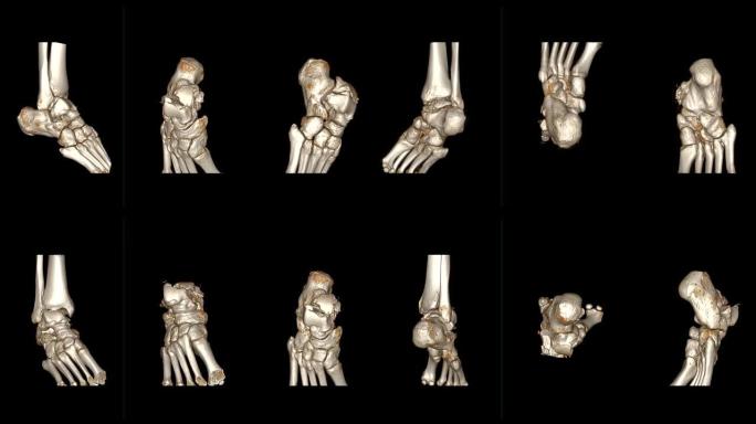 CT踝关节或右踝关节的ct扫描3D渲染图像在屏幕上旋转显示距骨骨折。