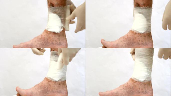 人们用绷带缠住双手，在疤痕，溃疡和老年斑周围，可能是由于他的腿静脉曲张。