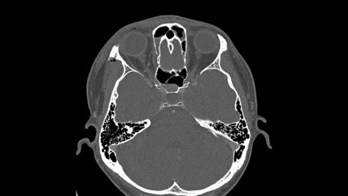 眼眶计算机断层扫描，男性，26岁交通事故移位骨折右眼眶外侧和内侧壁。医学图像。