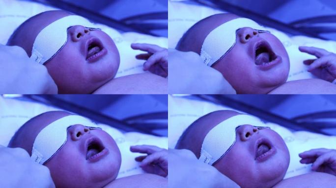 光疗灯下新生婴儿接受黄疸治疗