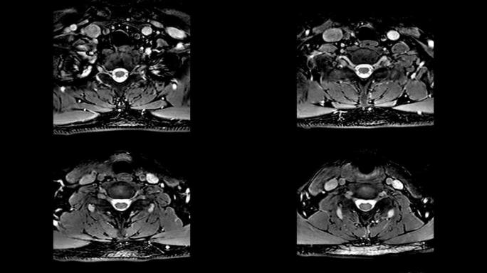 颈椎MRI，检测突起，突起和疝气