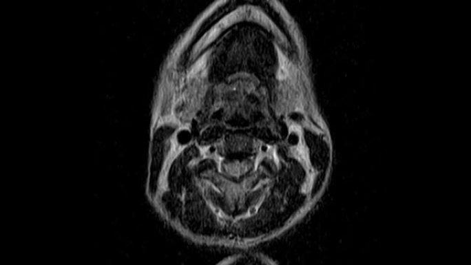 颈椎MRI，检测突起，突起和疝气