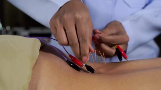 背部接受电刺激器针灸治疗的特写女性
