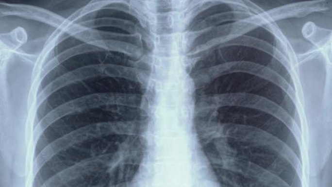肺癌或肺气肿