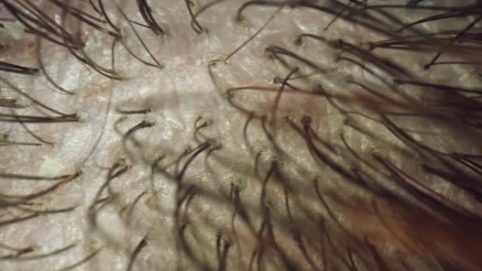 4k极端特写，人体头发和头皮的显微观察