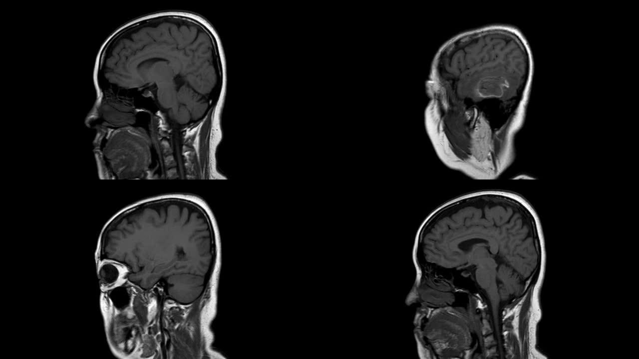 脑部磁共振成像 (MRI)，脑肿瘤