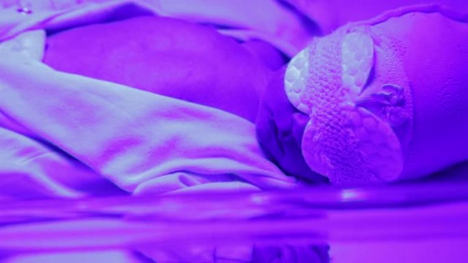 紫外线灯下的新生儿。