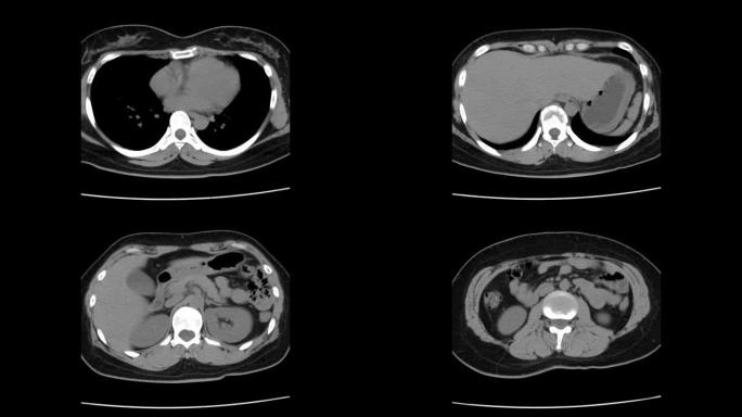 胸腰椎ct扫描显示T9和T10椎体轻度压缩性骨折。医学图像，全视时图像模糊。