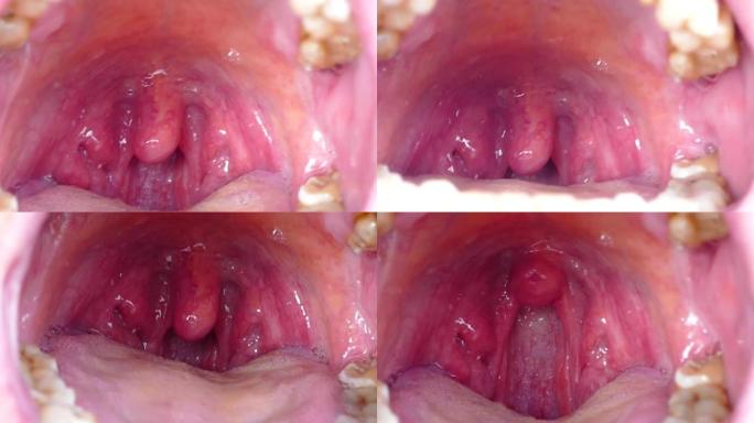 扁桃体畸形，扁桃体炎，被忽视的人口腔内部不好，