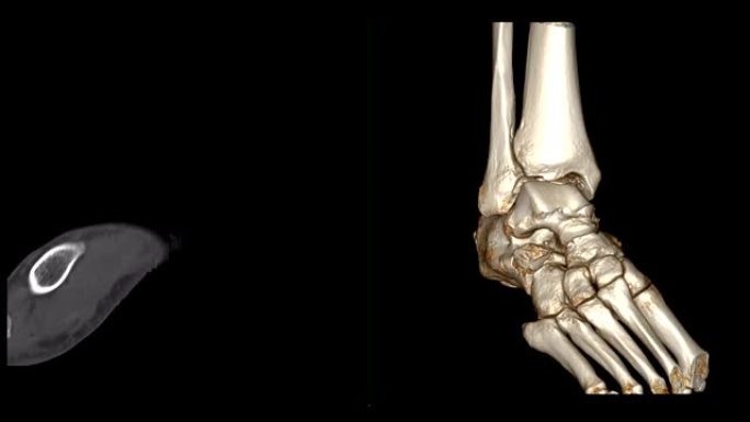 CT踝关节或右踝关节ct扫描2D矢状面，3D渲染显示距骨骨折。
