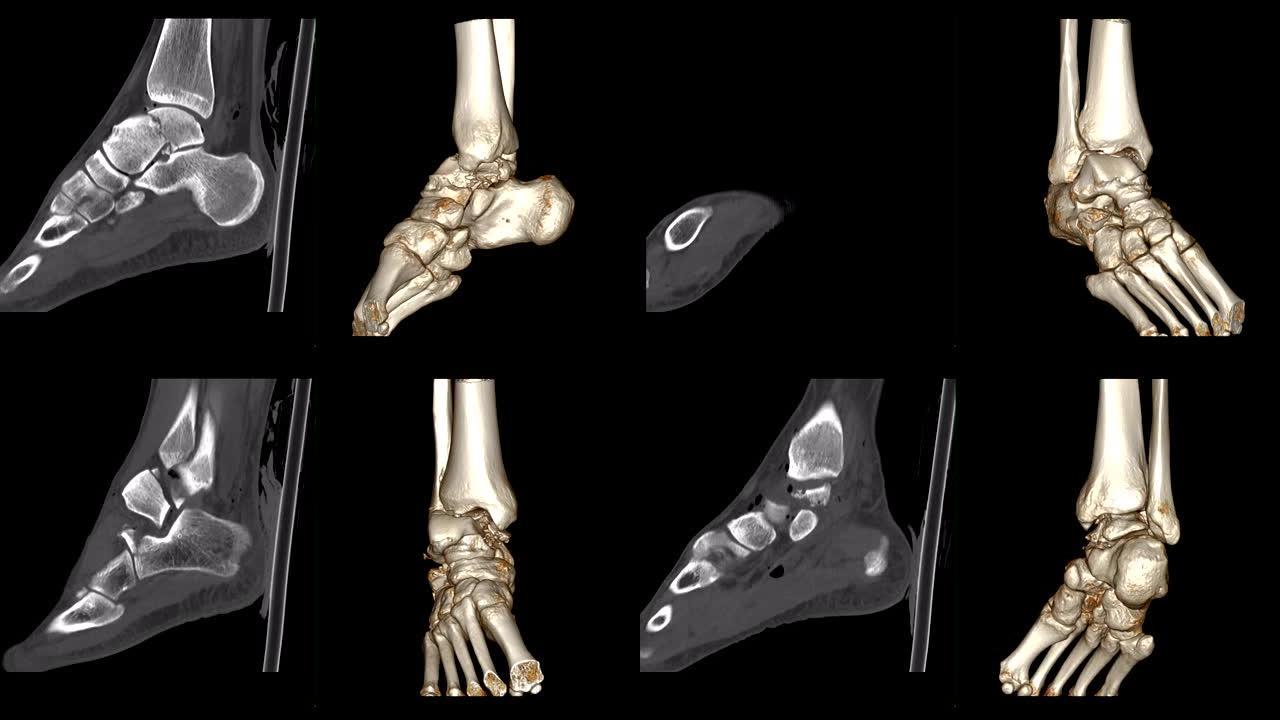 CT踝关节或右踝关节ct扫描2D矢状面，3D渲染显示距骨骨折。