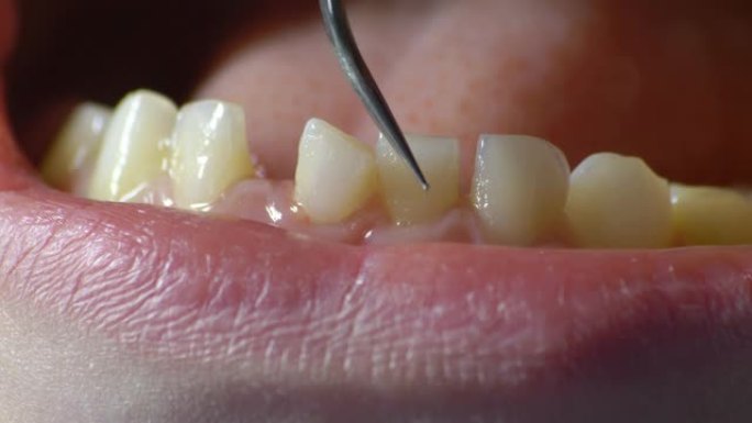牙医用牙科探针检查松动的牙齿
