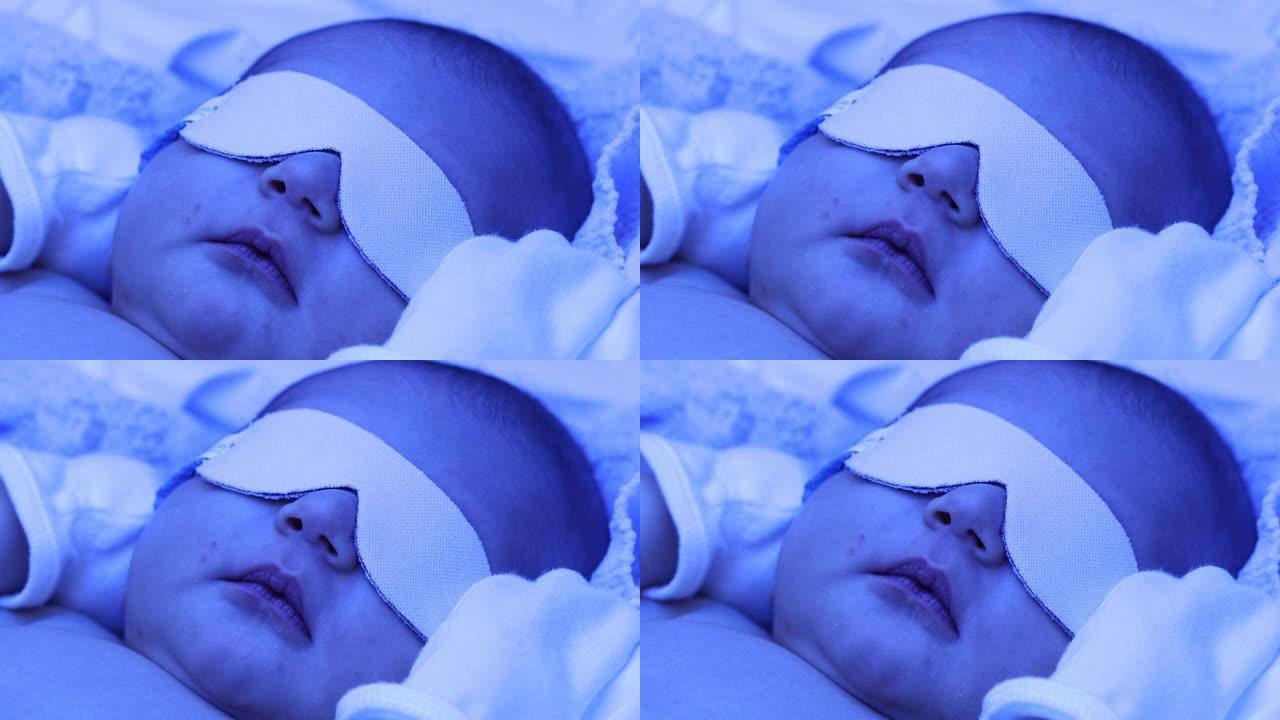 新生男婴在光疗灯下接受黄疸治疗