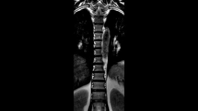 胸部脊的MRI扫描，检测脊柱上的突起和疝气
