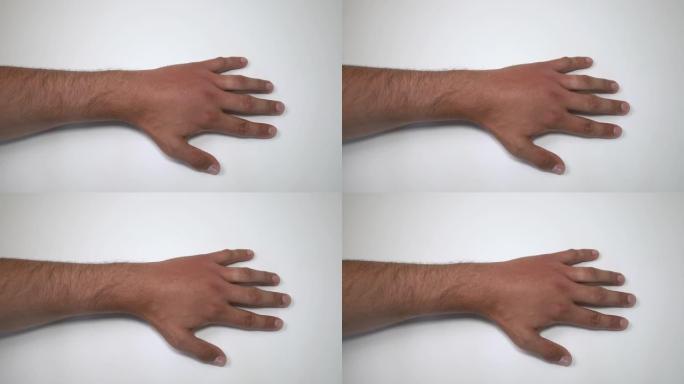 被蜜蜂或黄蜂蛰伤的雄性手。手部肿胀、发炎、发红是感染的征兆。左手昆虫叮咬