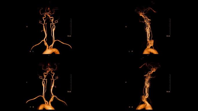 CTA脑或计算机断层扫描脑血管造影显示在屏幕上旋转的大脑颈总动脉的3D渲染图像。