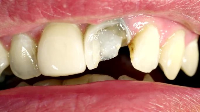断牙的嘴特写。男子展示了牙医治疗的空洞。