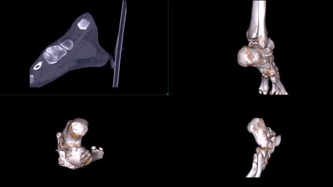 CT踝关节多视或右踝关节ct扫描二维矢状面和三维渲染显示距骨骨折 ..