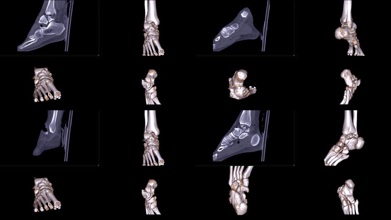 CT踝关节多视或右踝关节ct扫描二维矢状面和三维渲染显示距骨骨折 ..