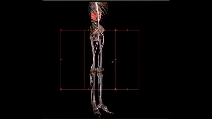 对于患有急性或慢性外周动脉疾病的患者，CTA股动脉偏离肾脏的股动脉3D渲染图像。