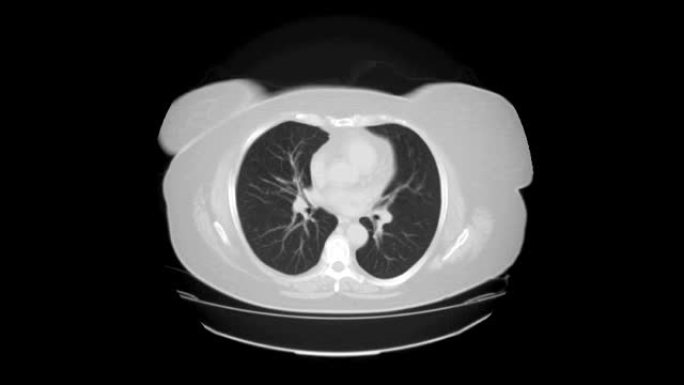 肺和支气管的MRI扫描，呼吸道疾病的诊断