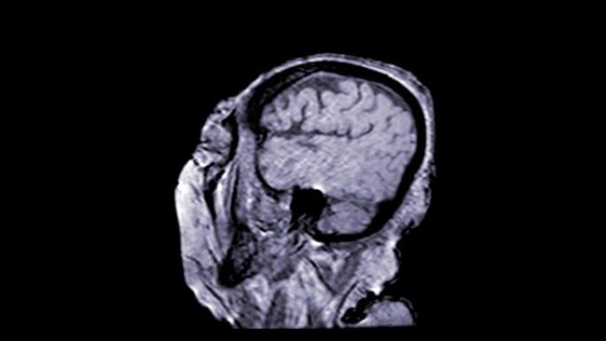 MRA脑或磁共振血管造影的脑矢状面观察慢动作，用于评估脑和脑动脉。