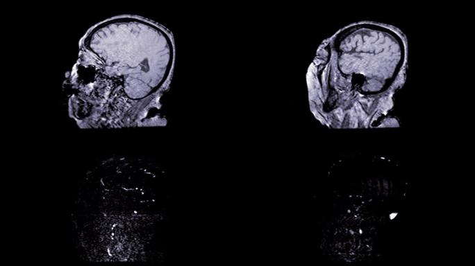 MRA脑或磁共振血管造影的脑矢状面观察慢动作，用于评估脑和脑动脉。