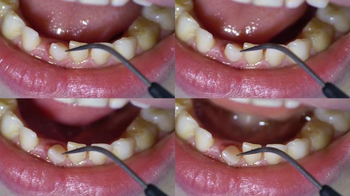 牙医用牙科探针检查松动的牙齿