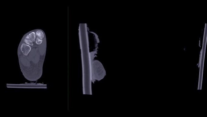 CT踝关节或右踝关节ct扫描比较轴、冠、矢状面显示距骨骨折。