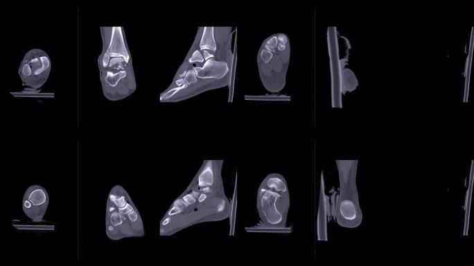 CT踝关节或右踝关节ct扫描比较轴、冠、矢状面显示距骨骨折。