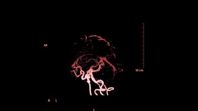 CTA脑或计算机断层扫描血管造影的大脑3D渲染图像显示大脑的脑动脉，透明的骨骼在屏幕上旋转。