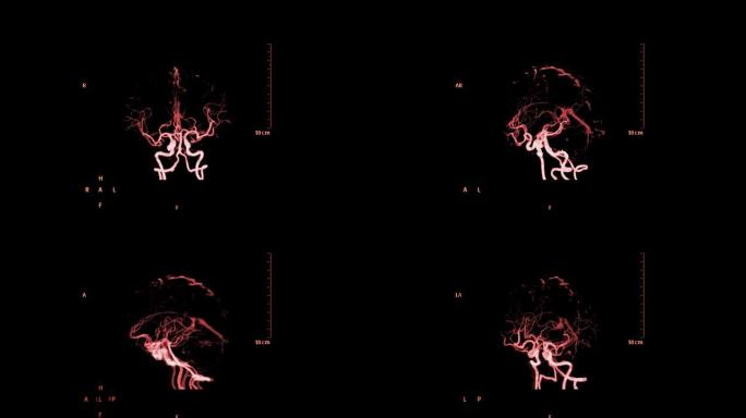 CTA脑或计算机断层扫描血管造影的大脑3D渲染图像显示大脑的脑动脉，透明的骨骼在屏幕上旋转。