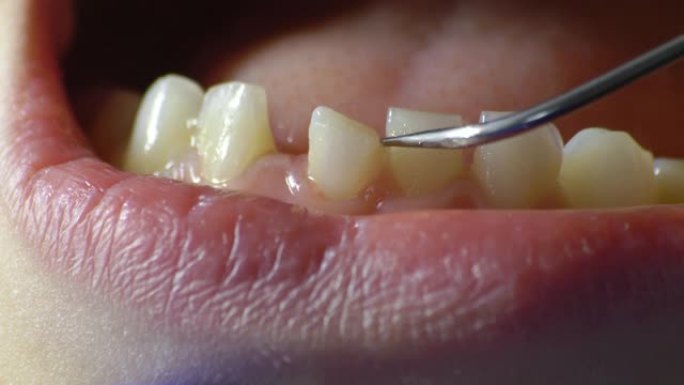 牙医用牙科探针检查松动的牙齿