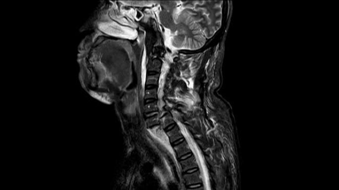 颈椎MRI病史: 表现为交通事故史及颈椎损伤后脱位、病灶外及模糊全解。医学概念