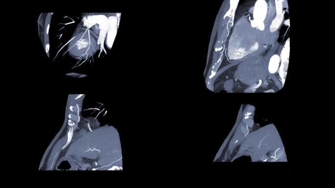 CTA冠状动脉3D渲染图像在屏幕上翻转以诊断血管冠状动脉狭窄。