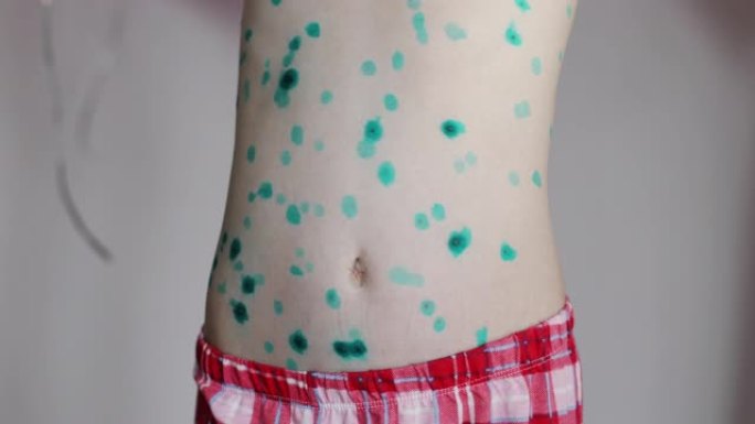 水痘。一个女孩得了水痘。